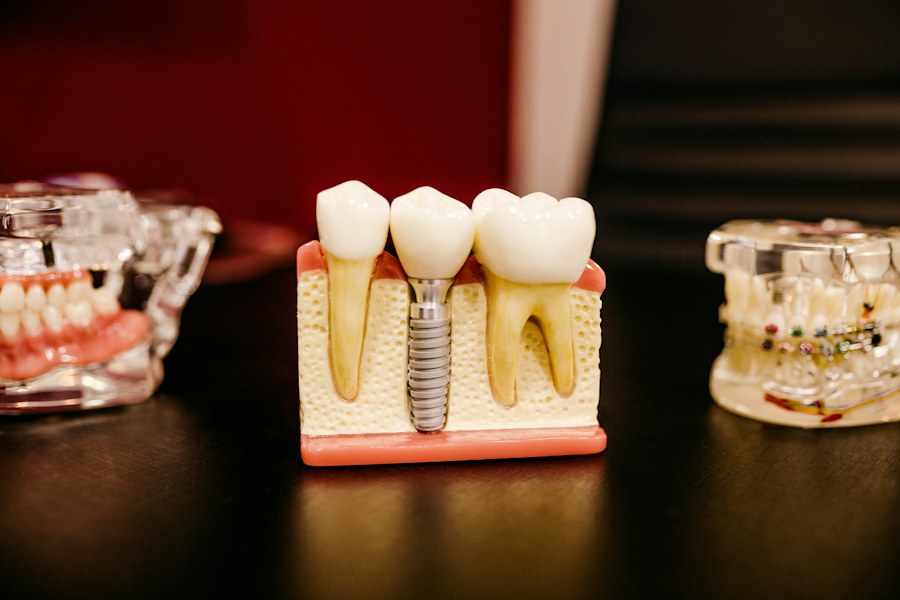 Modelo odontológico ilustrando um implante dentário