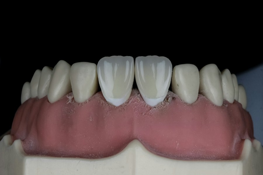 Modelo odontológico ilustrando dentes e gengivas